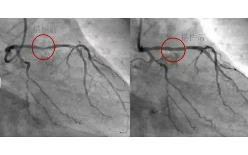 深圳市模具廠對(duì)心臟支架的關(guān)注，國(guó)產(chǎn)化的道路有多長(zhǎng)？